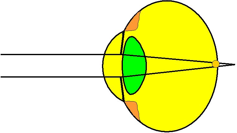Grafische Darstellung eines zu kurzen Augapfels. Die Lichtstrahlen treffen sich hinter der Netzhaut.
