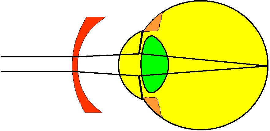 Grafische Darstellung eines zu langen Augapfels mit einer korrigierenden Brille.